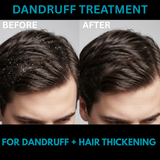 Hair Treatment Cream - Anti Dandruff + Hair Thickening